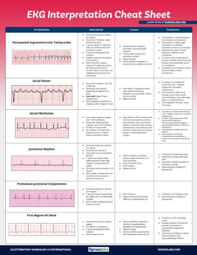 Free Printable Ekg Interpretation Cheat Sheet Dev onallcylinders