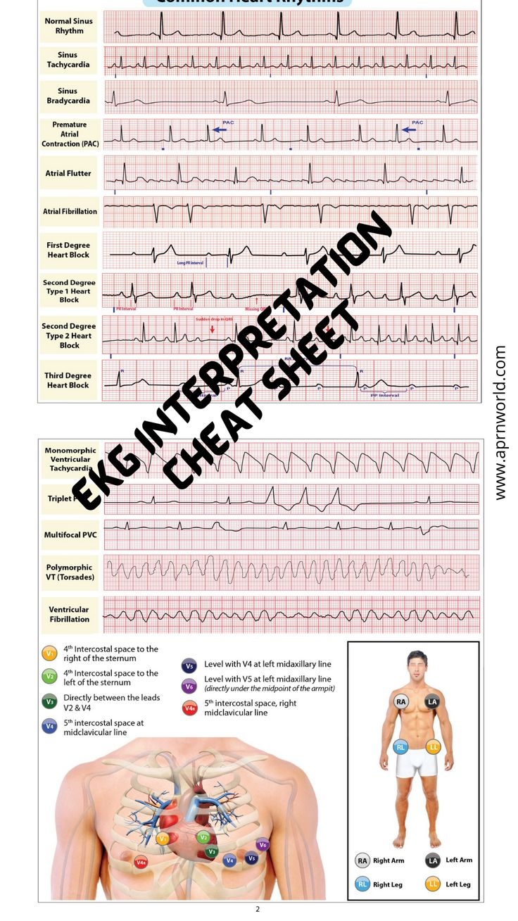 Free Printable Ekg Interpretation Cheat Sheet Printable Templates